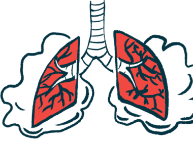 Sanfilippo lung health | Sanfilippo News | human lungs