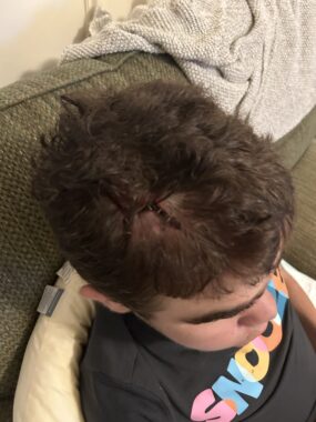 A close-up shows the top of a teenage boy's head, where a large laceration is visible that required a trip to the ER for staples to be placed. The boy is sitting on a couch and looking down. 